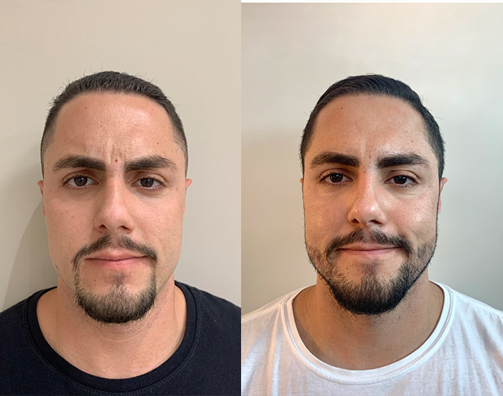 Antes-e-depois-angelica-5