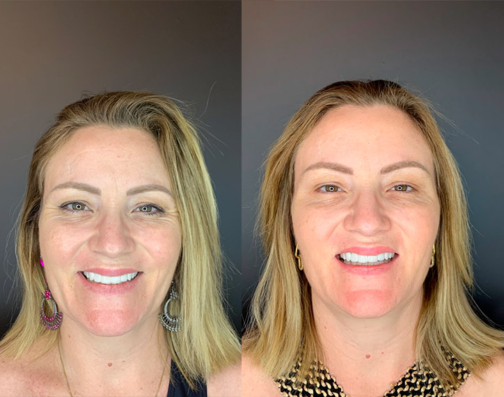 Antes-e-depois-angelica-6