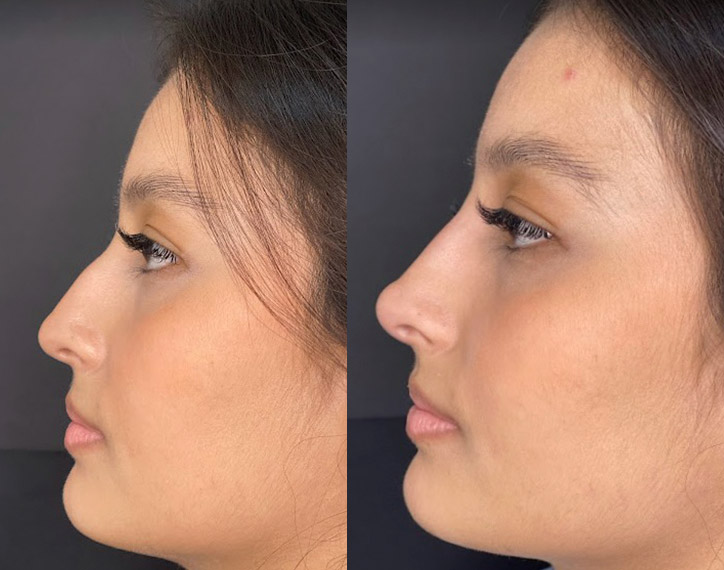 Antes-e-depois-angelica-7