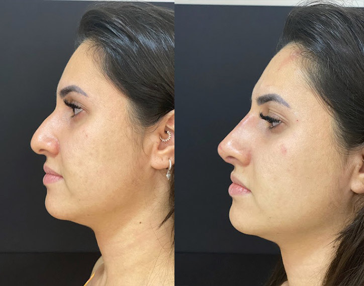 Antes-e-depois-angelica-8