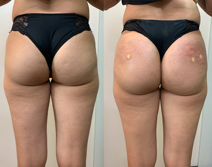 Antes-e-depois-angelica